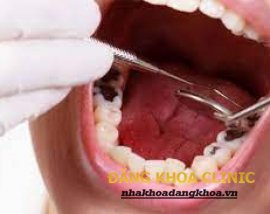 Nguyên nhân và cách chữa trị bệnh sâu răng ?