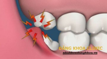 Những điều cần biết về răng khôn và hậu quả nghiêm trọng của nó