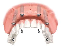 Implant cho hàm mất răng toàn bộ