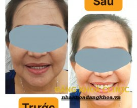 Hình ảnh trước và sau khi gắn răng nguyên hàm của chị khách nhà em