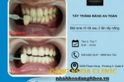 Càng tẩy càng trắng bất nhờ bật tone sau 2 lần tẩy trắng bằng Laser