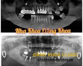 Phục hình Implant - Cách khắc phục tình trạng mất răng an toàn nhất
