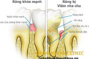 SỰ ĐÁNG SỢ CỦA VIÊM NHA CHU